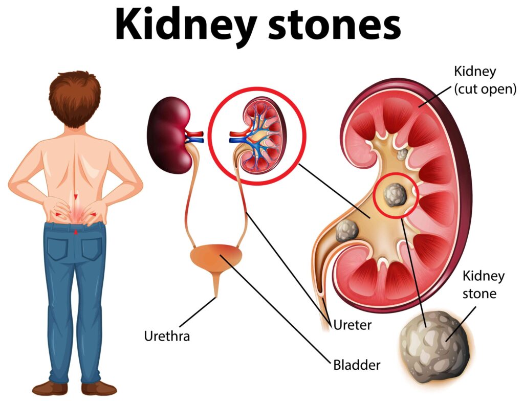 Kidney stones diagram showing location in kidney, ureter, bladder, and symptoms