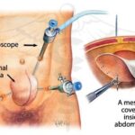Laparoscopic hernia surgery showing mesh repair inside abdominal wall