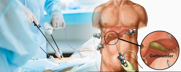 Gallbladder Removal Surgery in Ahmedabad using laparoscopic technique with surgical ports on abdomen