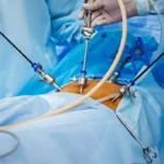 Surgeon performing laparoscopic hernia repair treatment with precision instruments in minimally invasive procedure