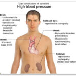Hypertension complications in brain, heart, kidneys, eyes, and blood vessels